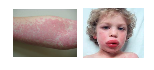 IgE vs IgG Allergy